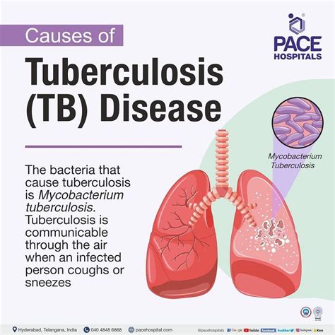 bad tb|Tuberculosis (TB): Causes, Symptoms, Treatment